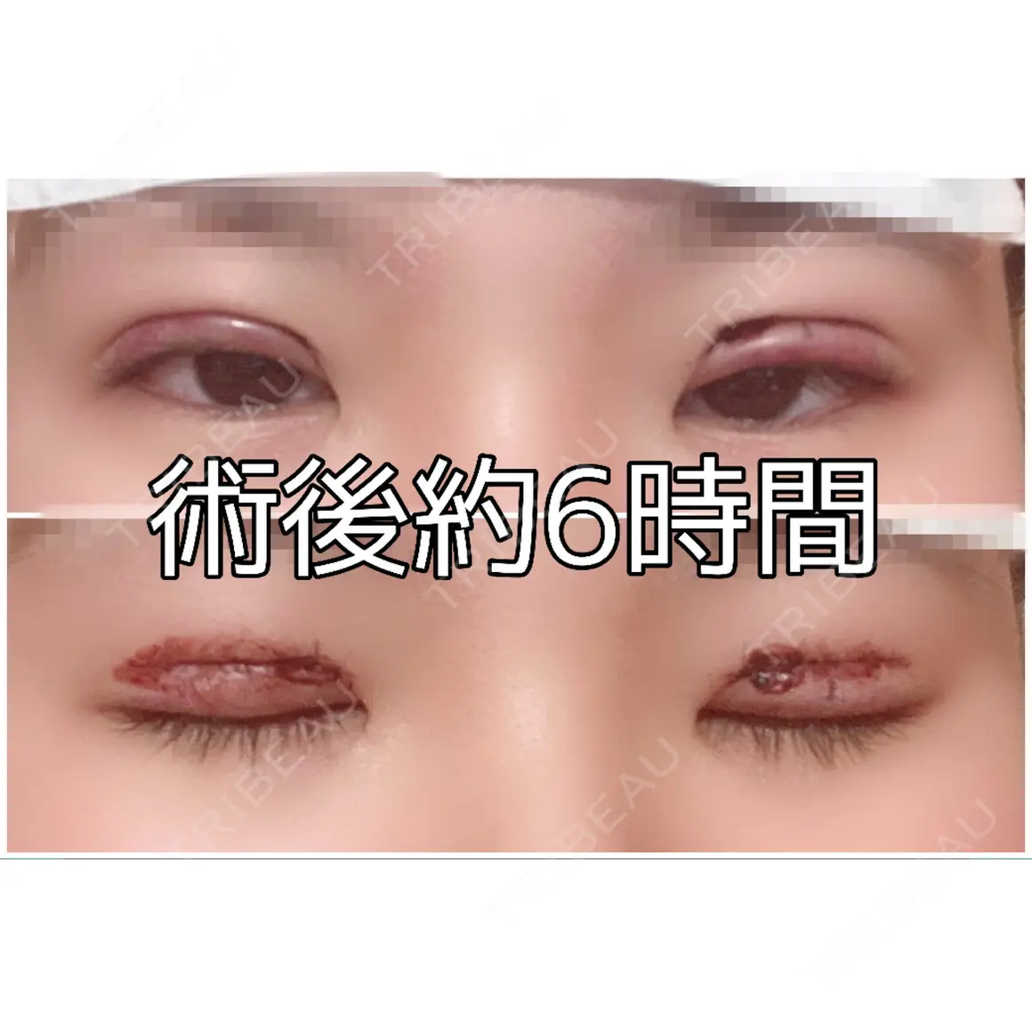 二重切開 高須クリニック 名古屋院 DAY 0