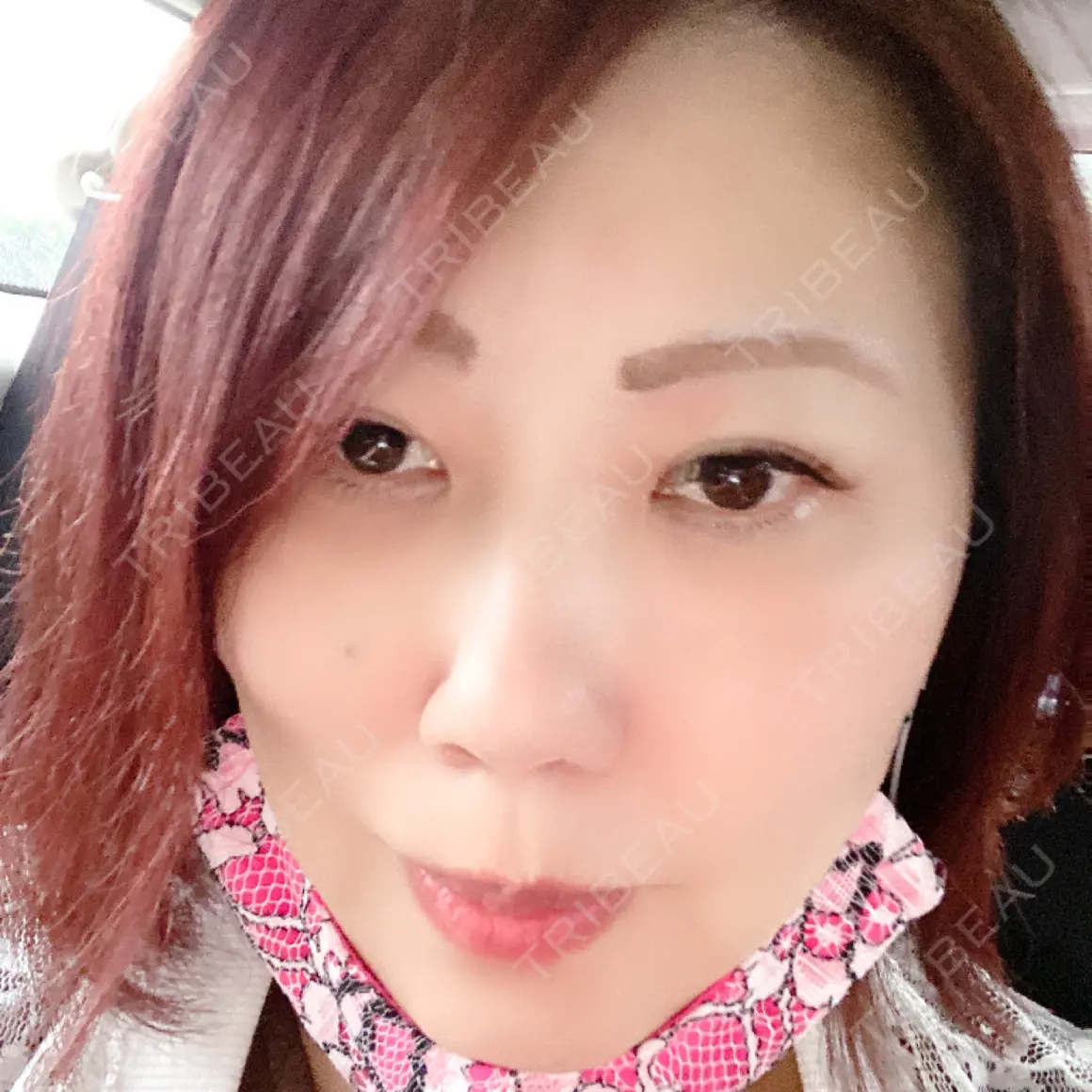下まぶたの脂肪取り 湘南美容クリニック 千葉センシティ院 AFTER
