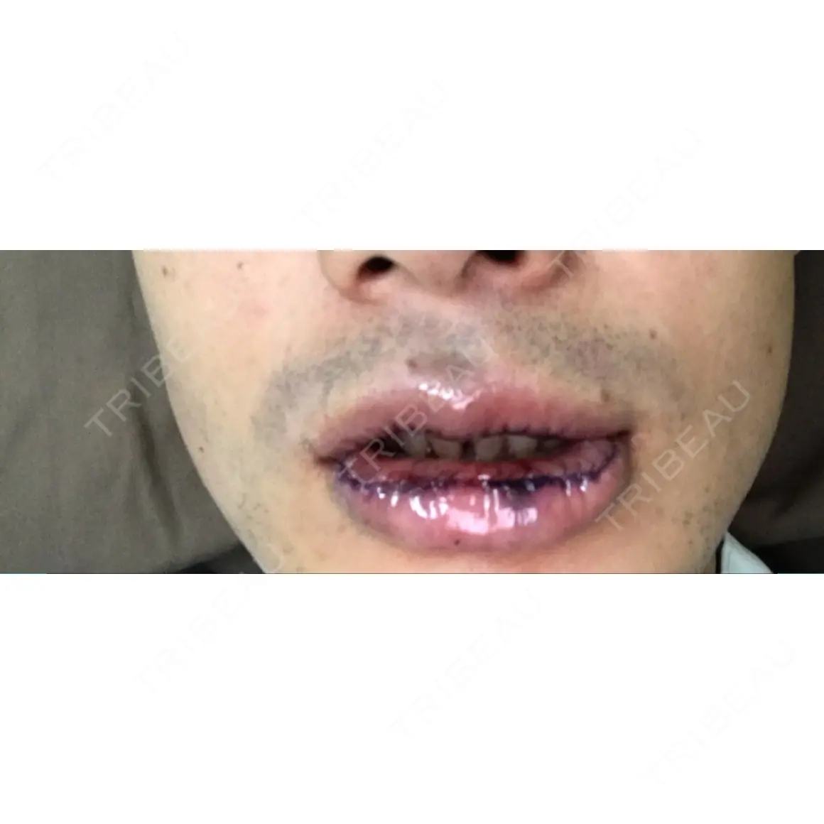 口唇縮小術 クリニカ市ヶ谷 DAY 0