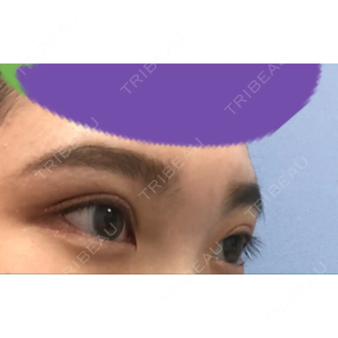 二重埋没 湘南美容クリニック 西葛西院 AFTER