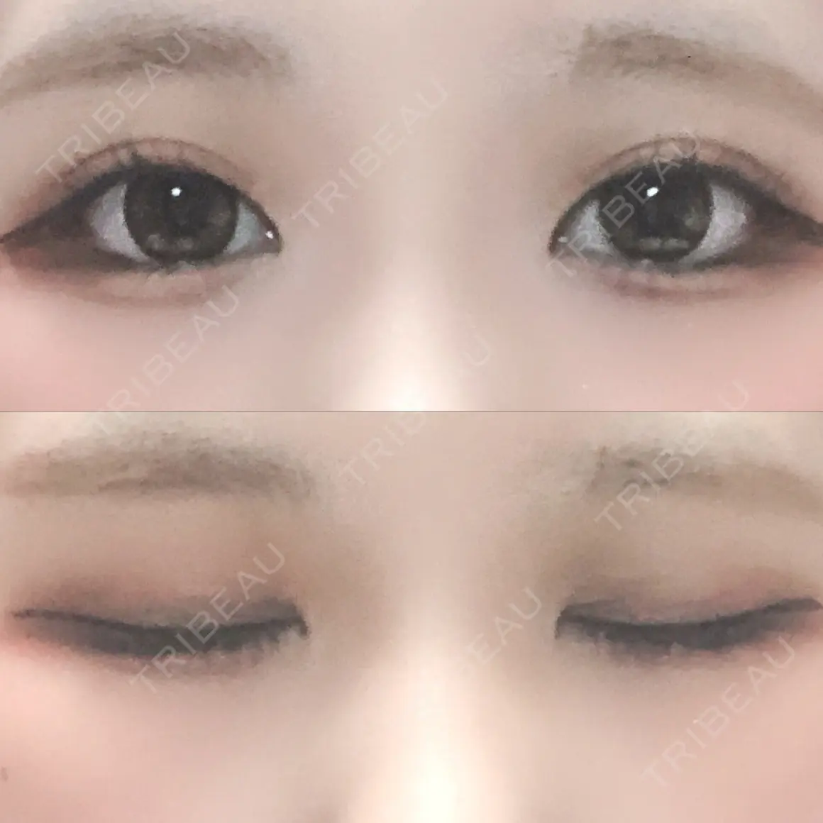 二重埋没 湘南美容クリニック 新宿南口院 AFTER