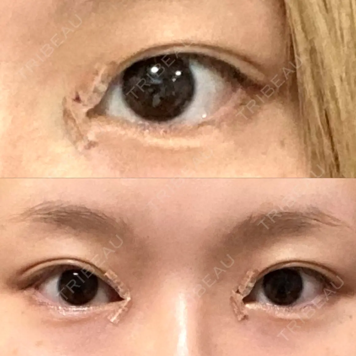 目頭切開 品川美容外科 新宿院（※品川スキンクリニック提携） DAY 0