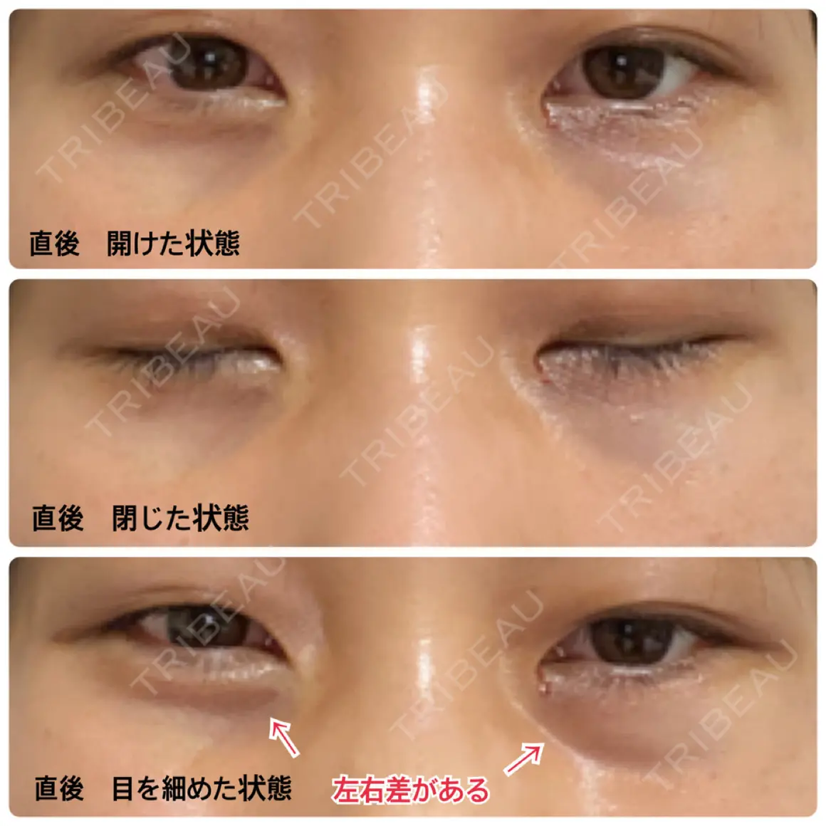 クマ治療 / 下まぶたの脂肪取り 品川美容外科 渋谷院（※品川スキンクリニック提携） DAY 0
