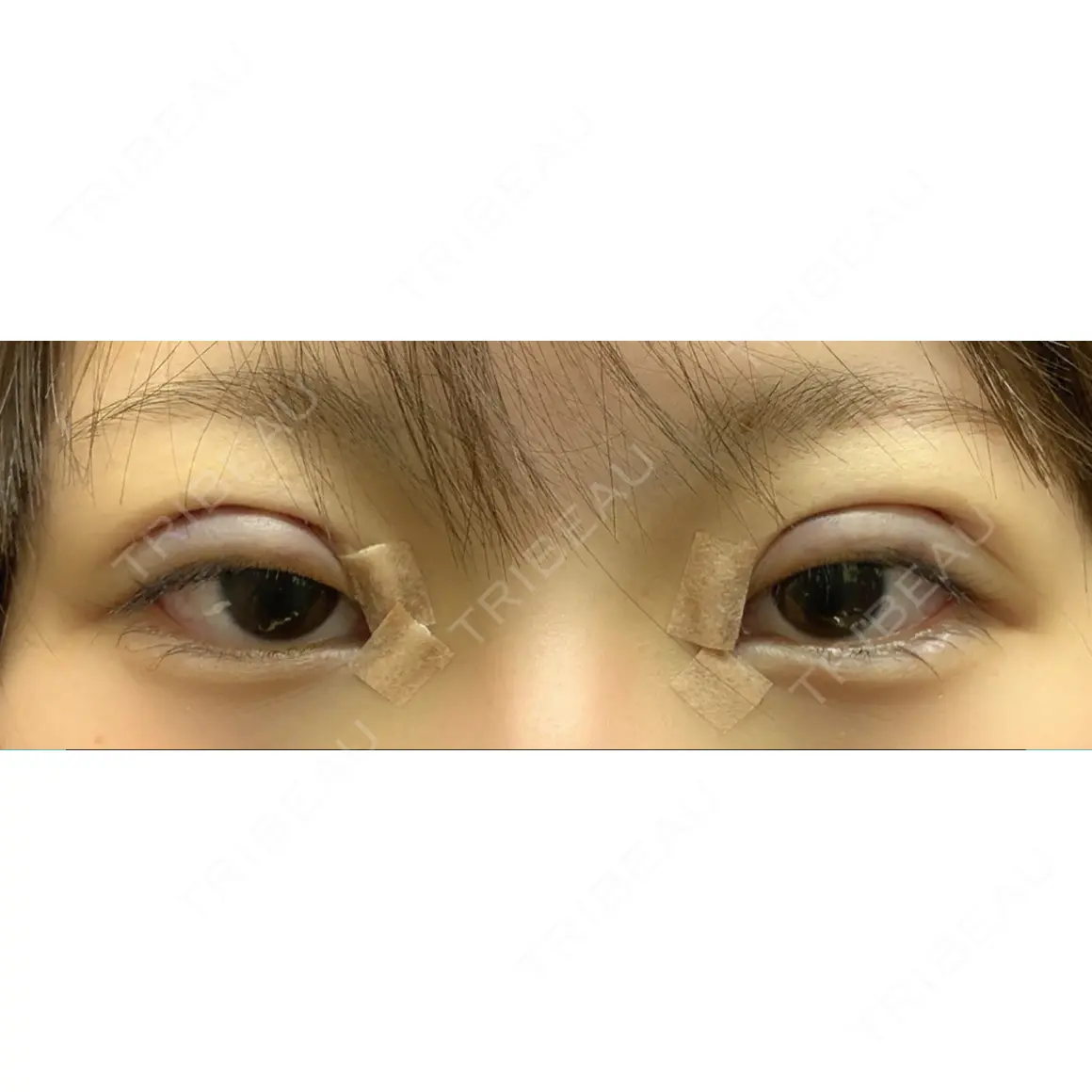 二重切開 / 目頭切開 サラ美容外科 DAY 0