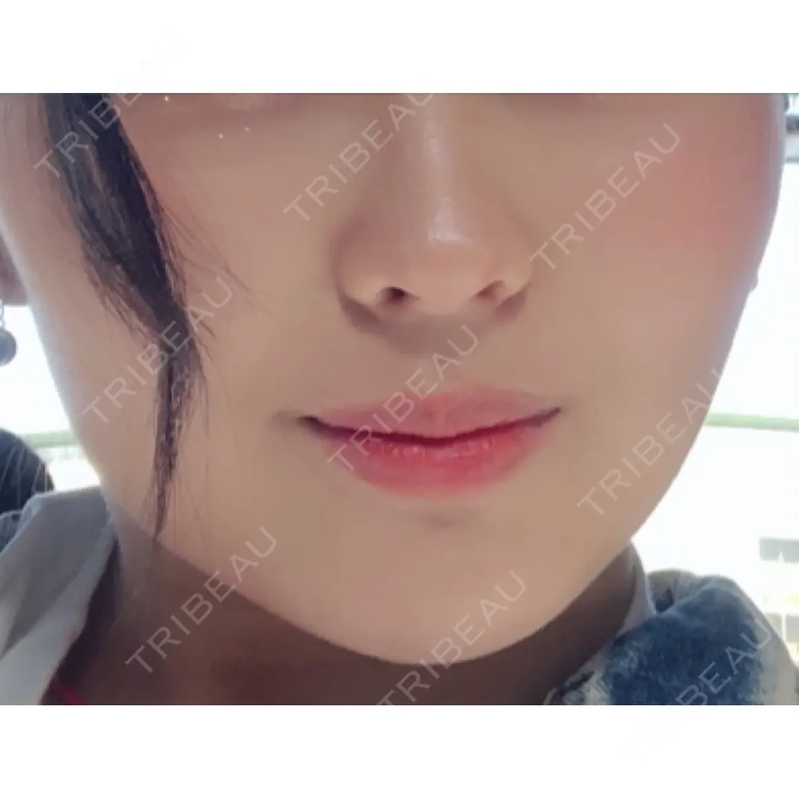 ボトックス（エラ・小顔） 品川美容外科 大宮院 AFTER