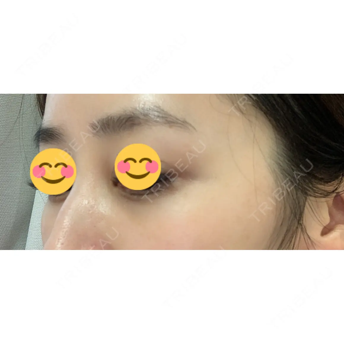 下まぶたの脂肪取り セオリークリニック AFTER