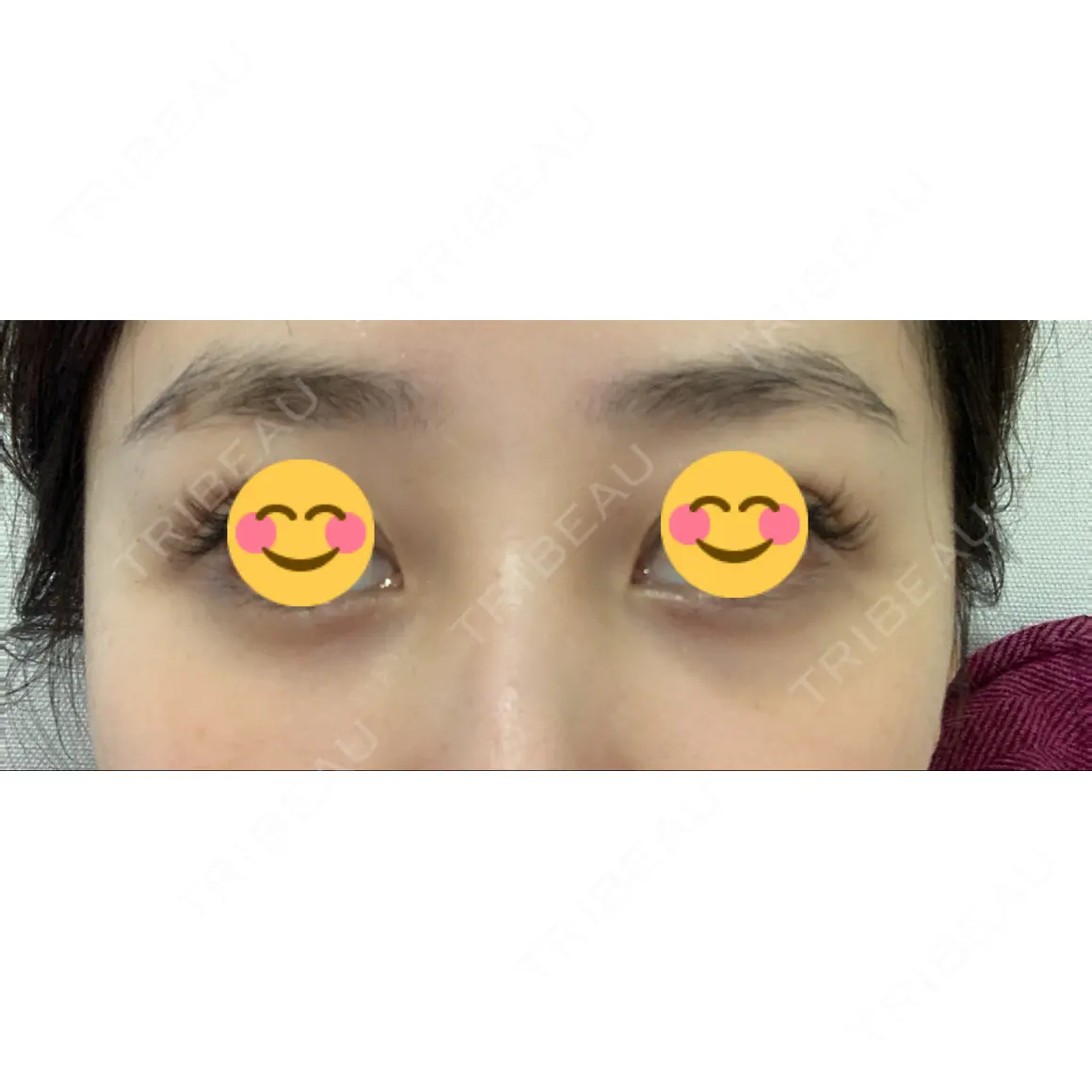 下まぶたの脂肪取り セオリークリニック AFTER
