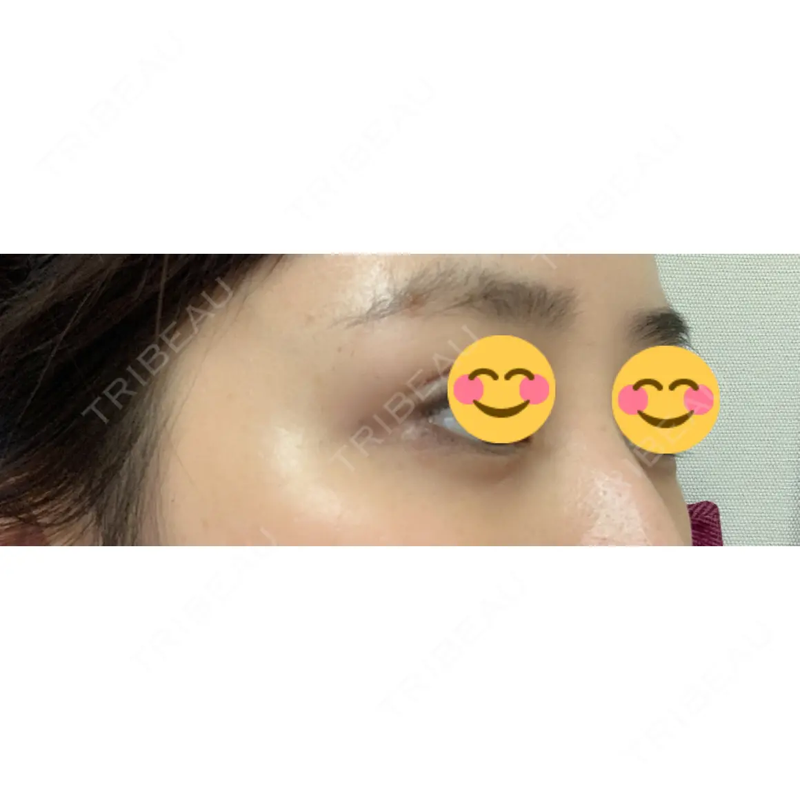 下まぶたの脂肪取り セオリークリニック AFTER