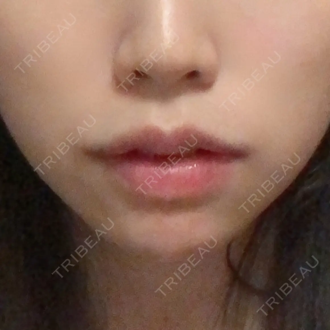 ヒアルロン酸注入（唇） / ボトックス（口角） ルラ美容クリニック 新宿院 DAY 0
