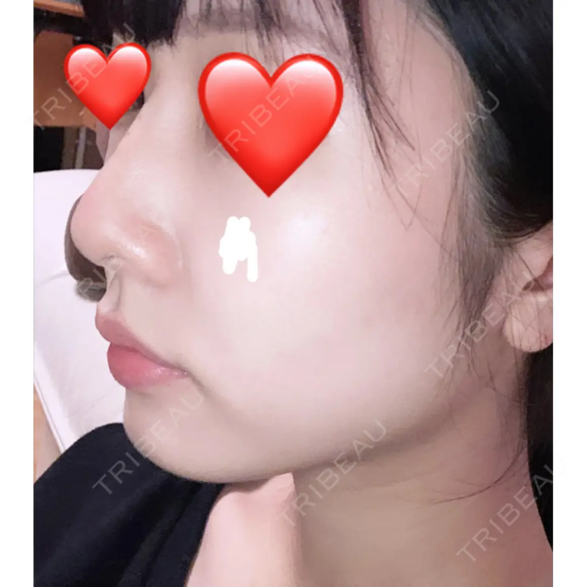 ヒアルロン酸注入（鼻） 青山外苑前クリニック DAY 0