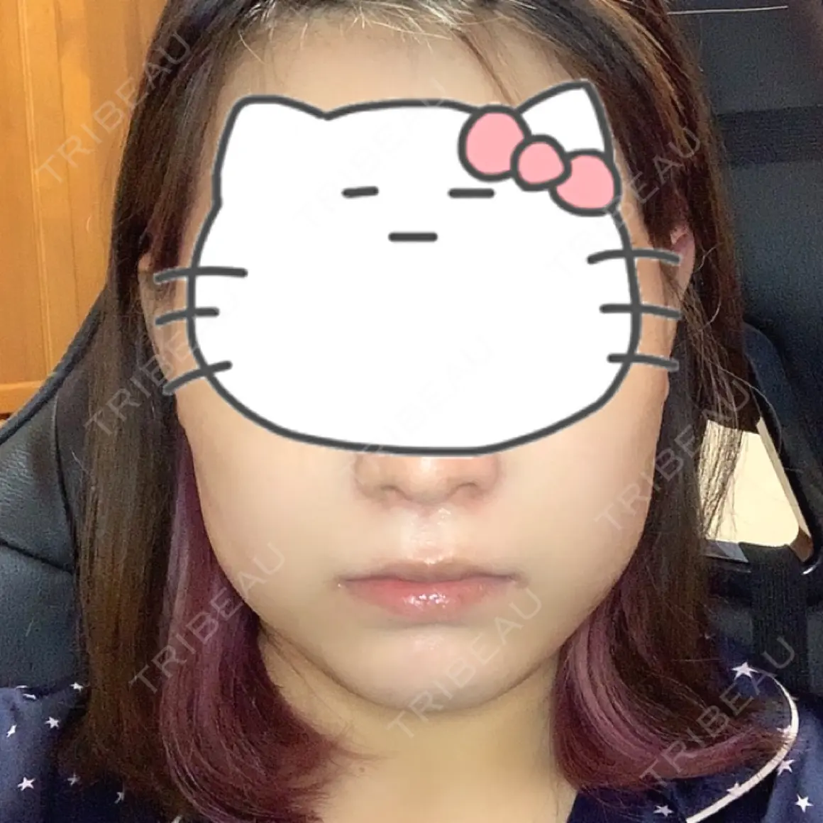 脂肪溶解注射（顔） 東京ロイヤルクリニック DAY 0