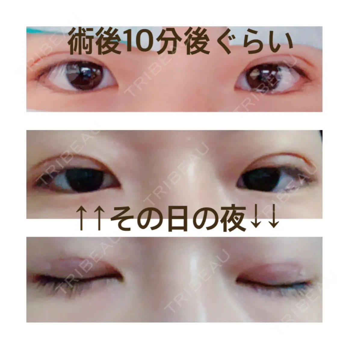二重埋没 / 上まぶたの脂肪取り 共立美容外科 大宮院 DAY 0