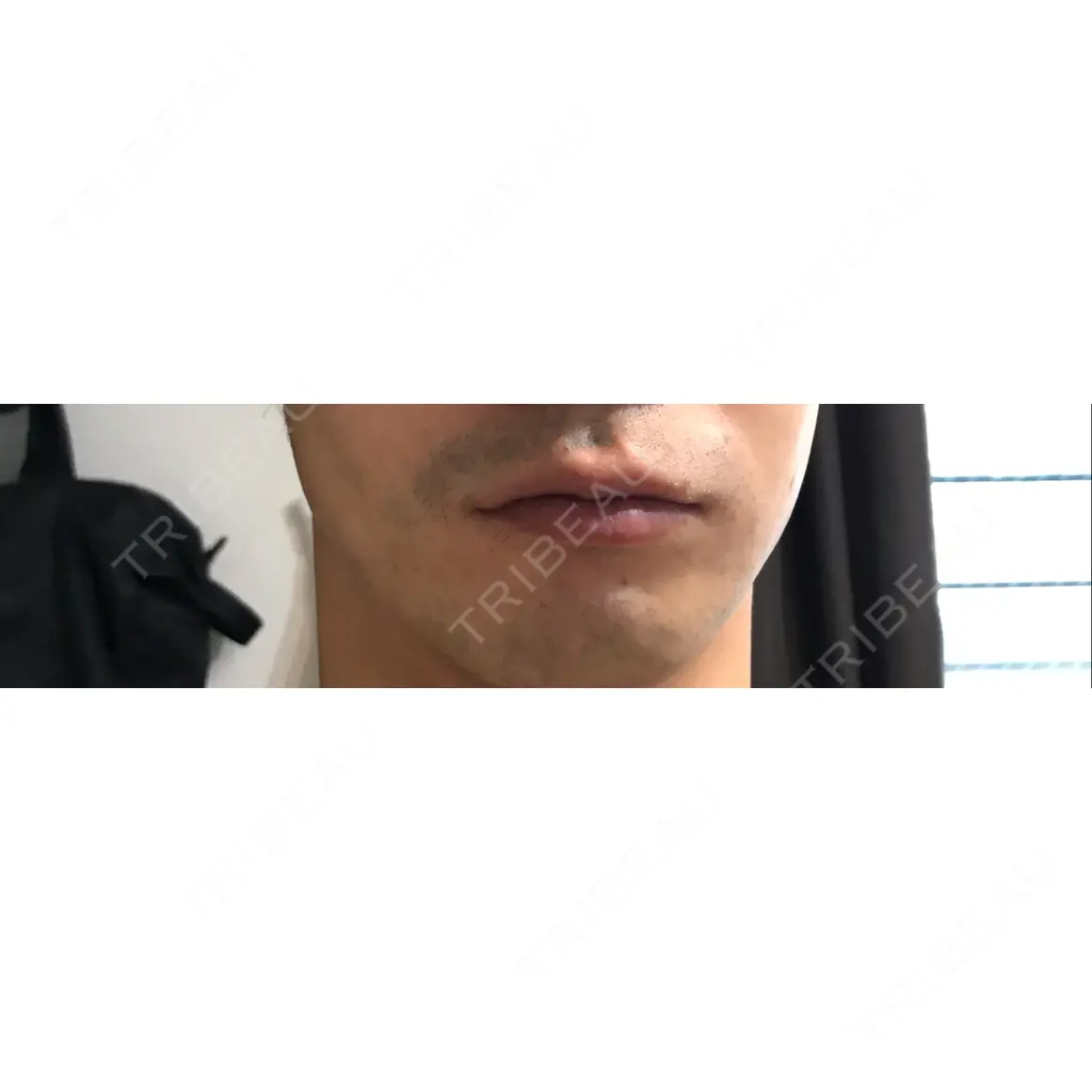 口唇縮小術 クリニカ市ヶ谷 AFTER