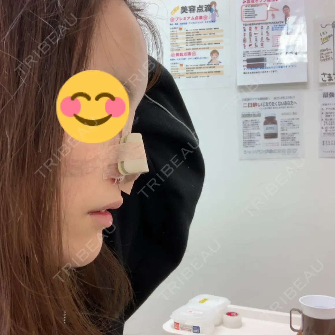 隆鼻術 / 鼻尖形成（切開） / 鼻尖縮小 グローバルビューティークリニック 大阪院 DAY 0