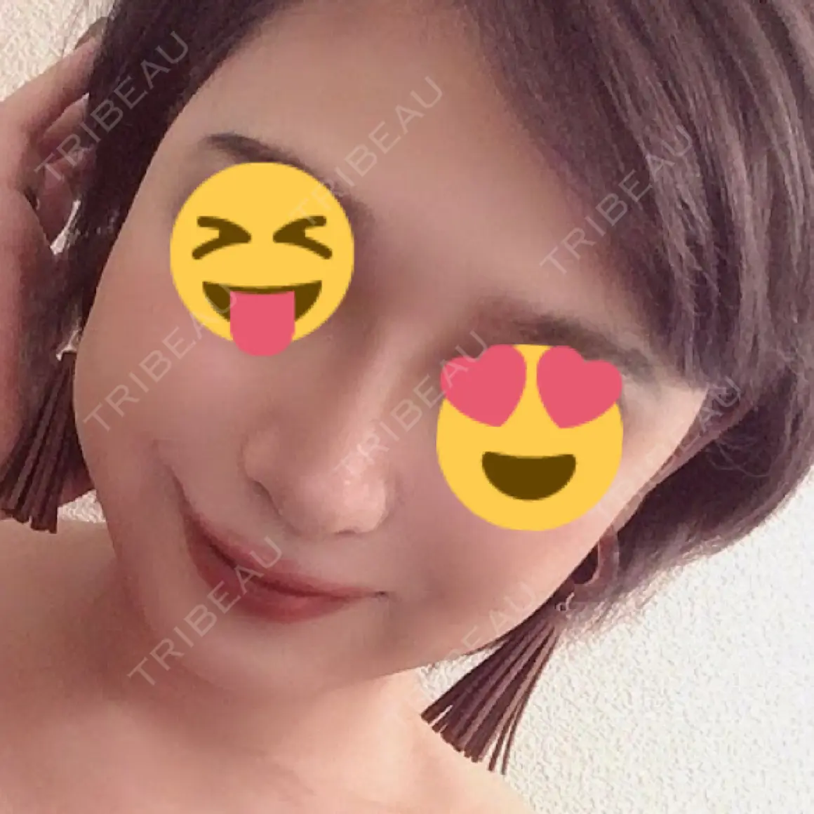 隆鼻術 / 鼻尖形成（切開） / 鼻中隔延長（切開） / 軟骨移植 札幌ル・トロワ ビューティクリニックVogue AFTER