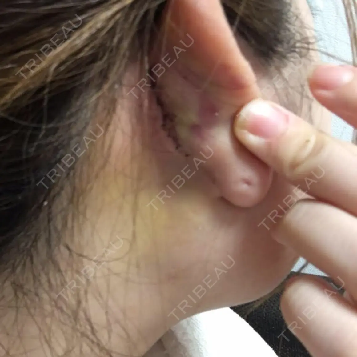 二重切開 / 目頭切開 / 眼瞼下垂（切開） / 隆鼻術 / 鼻尖形成（切開） / タレ目形成・グラマラスライン（切開） / 軟骨移植 / プロテーゼ除去 / 鼻修正 / 鼻尖縮小 / その他（鼻） グローバルビューティークリニック 大阪院 DAY 4
