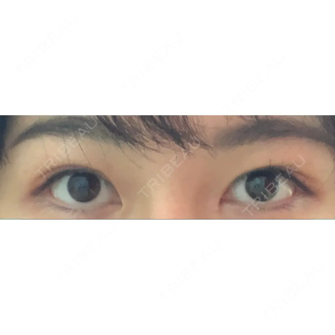 目頭切開 アロマ美容外科クリニック AFTER