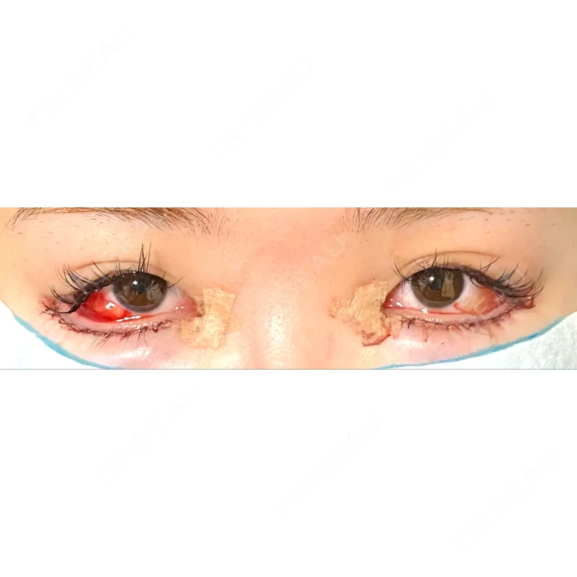 目頭切開 / 目尻切開 / タレ目形成・グラマラスライン（切開） あつぎ美容クリニック DAY 0
