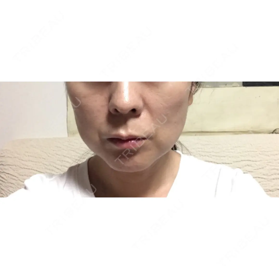 バッカルファット除去 高須クリニック 大阪院 AFTER