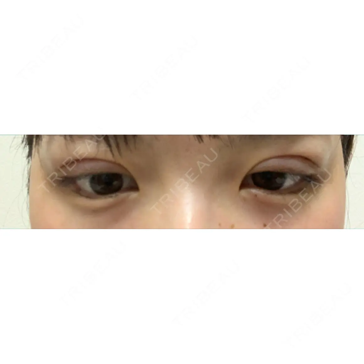 二重埋没 / 上まぶたの脂肪取り / 下まぶたの脂肪取り 東京形成美容外科 船橋院 DAY 0