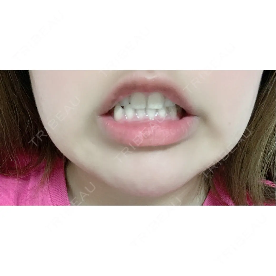 ガミースマイル手術 / ボトックス（あご） / ヒアルロン酸注入（あご） / ボトックス（口角） 有楽町美容外科クリニック AFTER