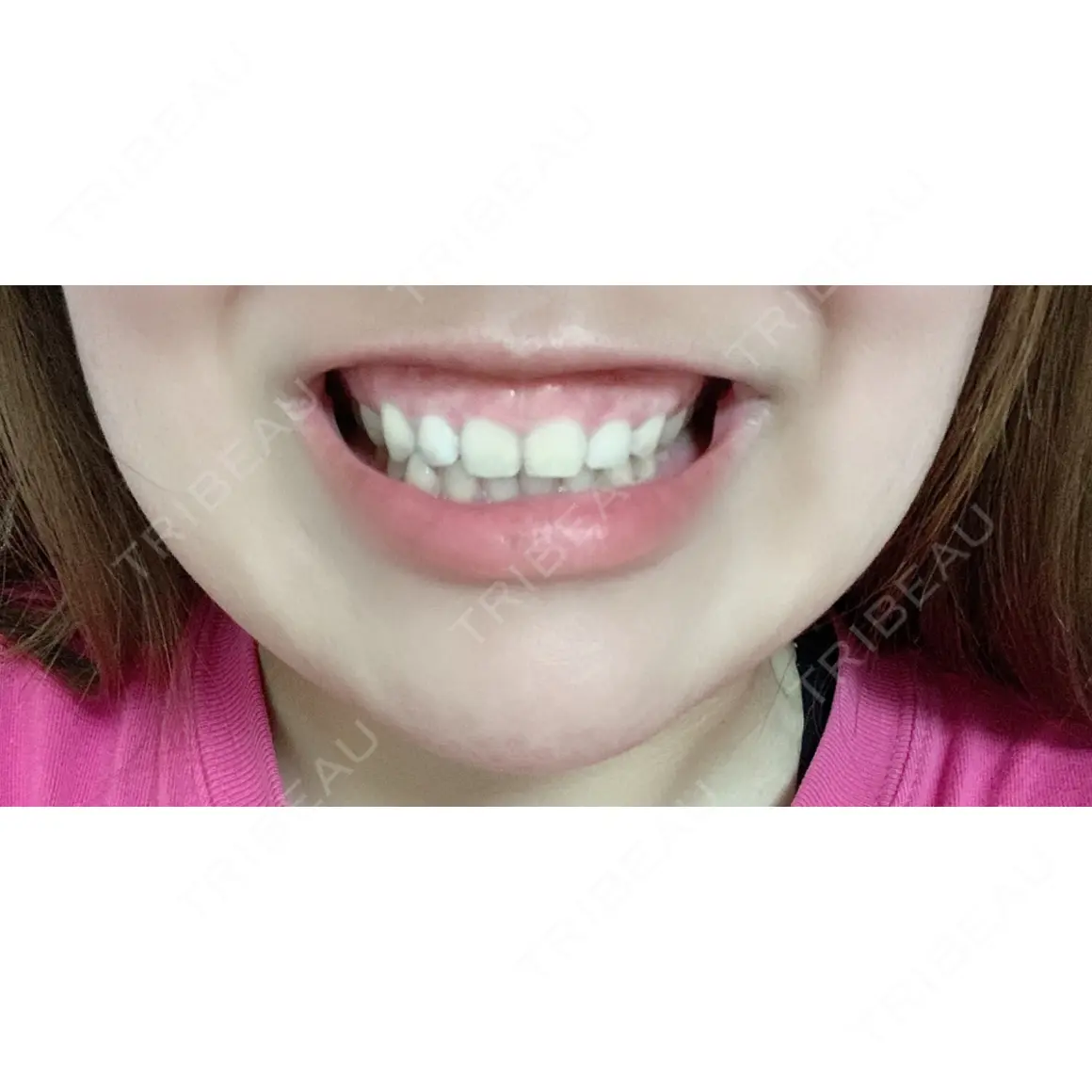 ガミースマイル手術 / ボトックス（あご） / ヒアルロン酸注入（あご） / ボトックス（口角） 有楽町美容外科クリニック AFTER