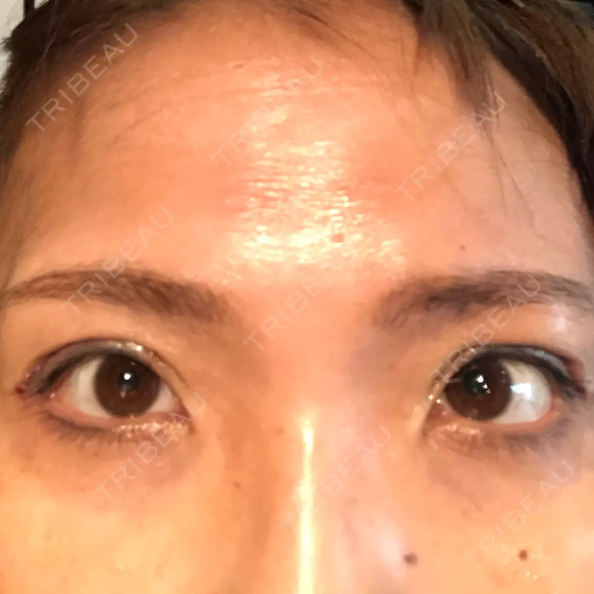 二重切開 / 眼瞼下垂（切開） / 上まぶたたるみ取り 湘南美容クリニック 高田馬場院 DAY 0