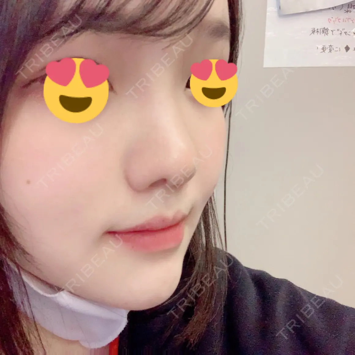 隆鼻術 / 鼻尖形成（切開） / 鼻中隔延長（切開） / 軟骨移植 グローバルビューティークリニック 大阪院 AFTER