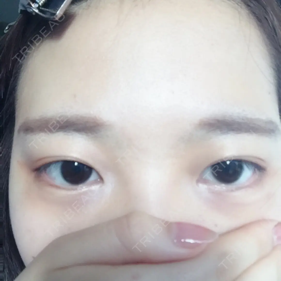 二重埋没 かわた美容クリニック AFTER