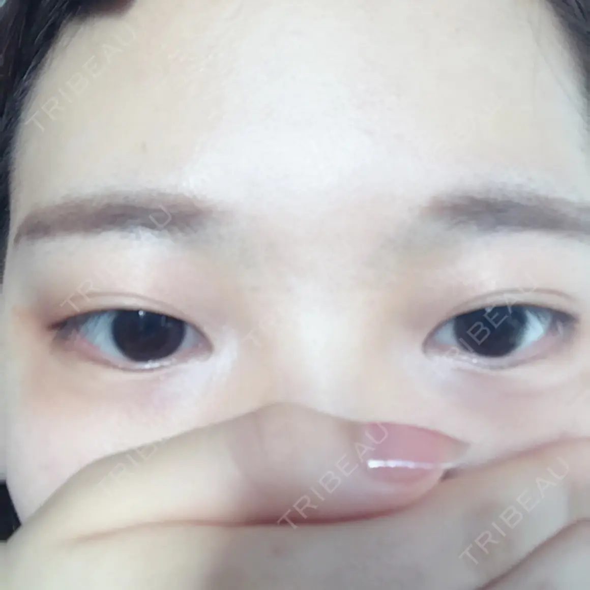 二重埋没 かわた美容クリニック AFTER