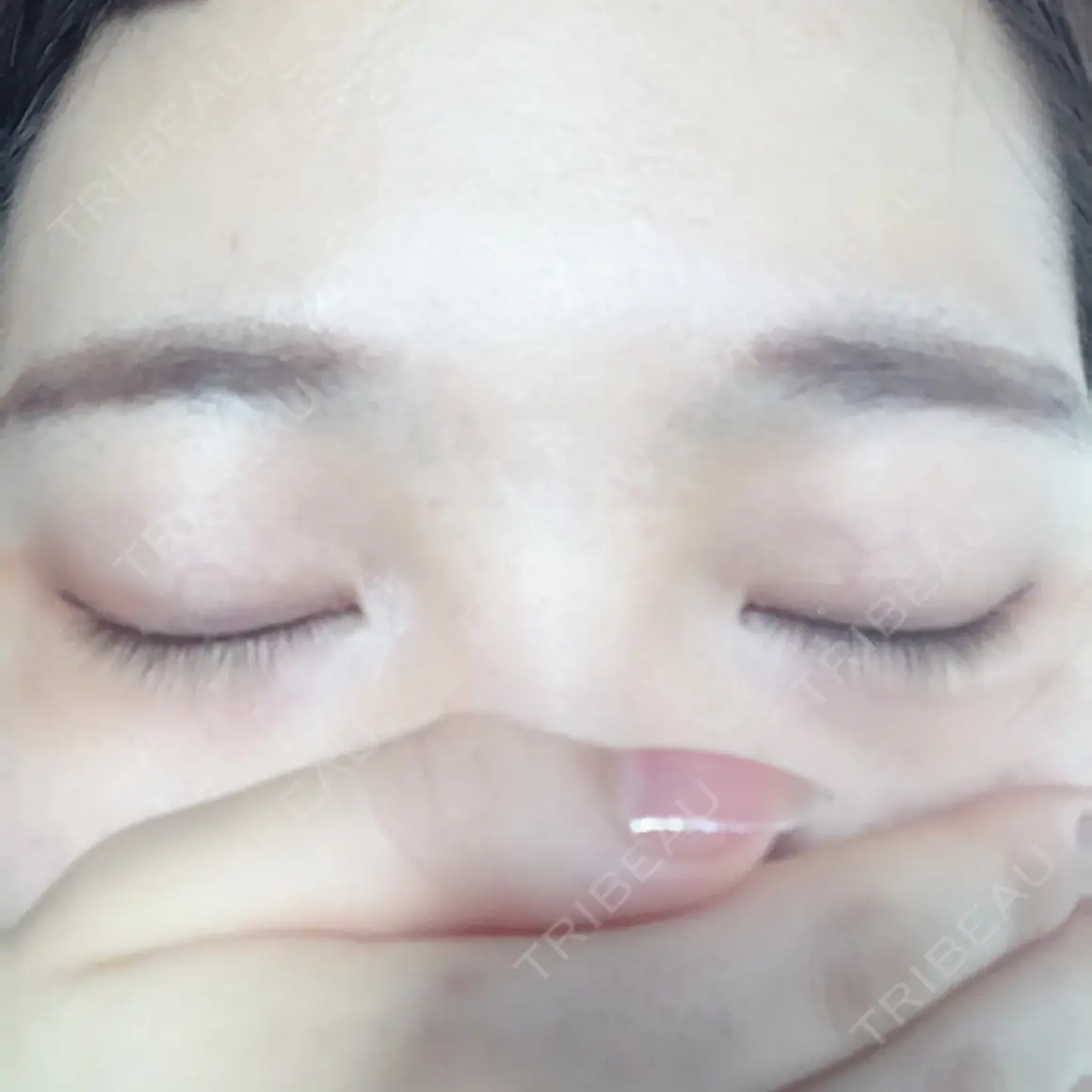 二重埋没 かわた美容クリニック AFTER