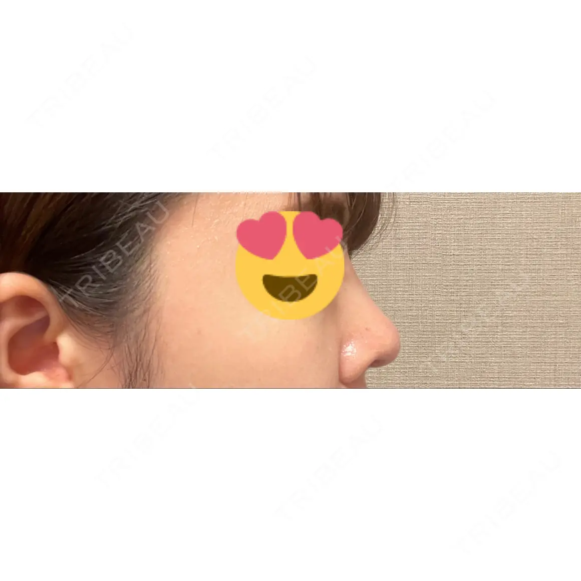 隆鼻術 / 鼻尖形成（切開） / 鼻中隔延長（切開） La Clinique Shinjuku 【ラクリニック 新宿】 AFTER