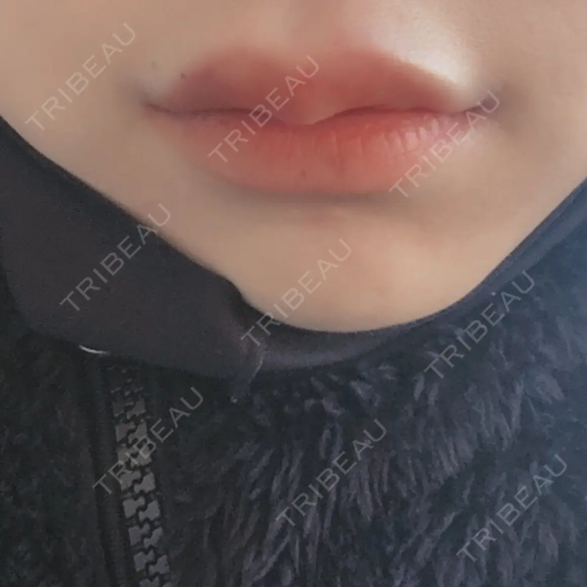 ヒアルロン酸注入（唇） 湘南美容クリニック 小倉院 AFTER