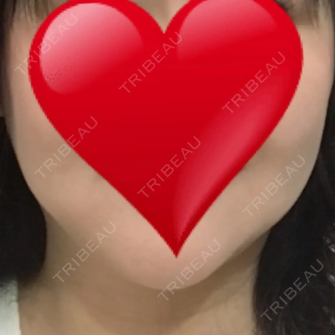 肌ヒアルロン酸注入（たるみ・シワ改善） TCB東京中央美容外科 枚方院 AFTER