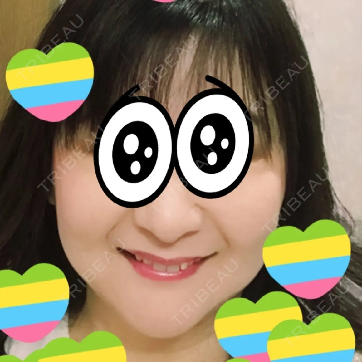 肌ヒアルロン酸注入（たるみ・シワ改善） TCB東京中央美容外科 枚方院 AFTER