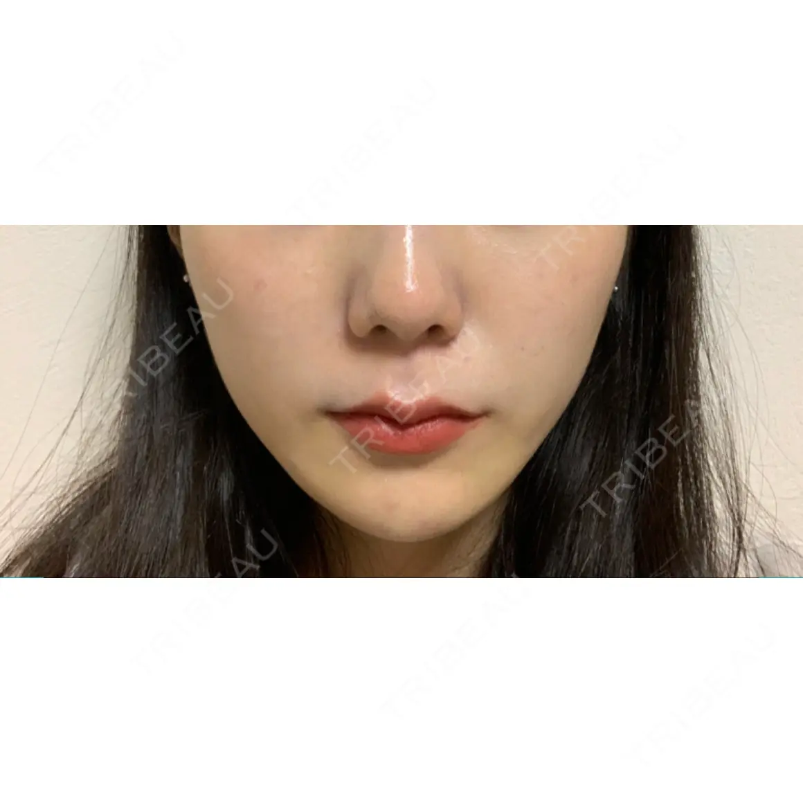 ヒアルロン酸注入（頬） 百人町アルファクリニック AFTER