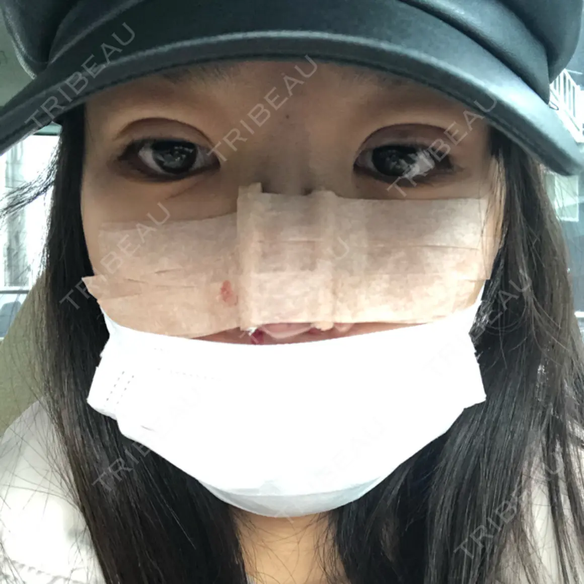 隆鼻術 / 鼻尖形成（切開） 品川美容外科 千葉院 DAY 0
