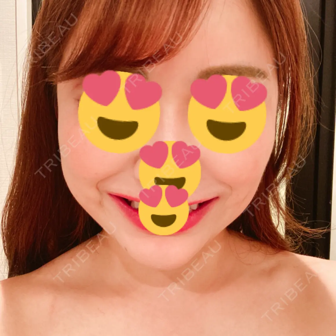 ハイフ（顔） 湘南美容クリニック 新宿本院 AFTER