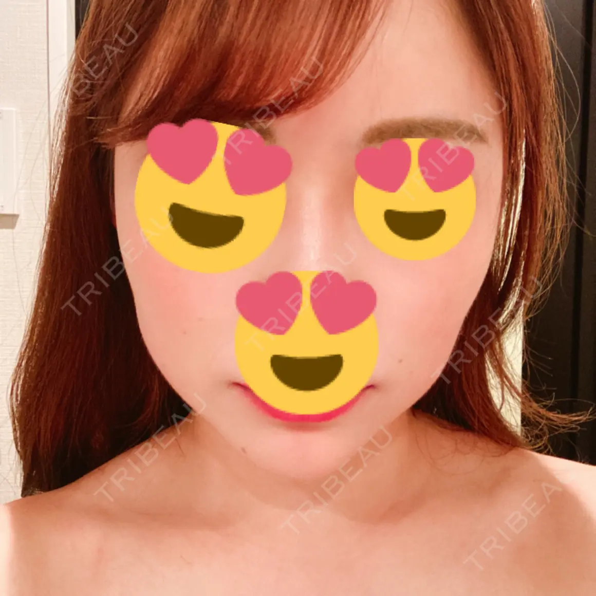 ハイフ（顔） 湘南美容クリニック 新宿本院 AFTER