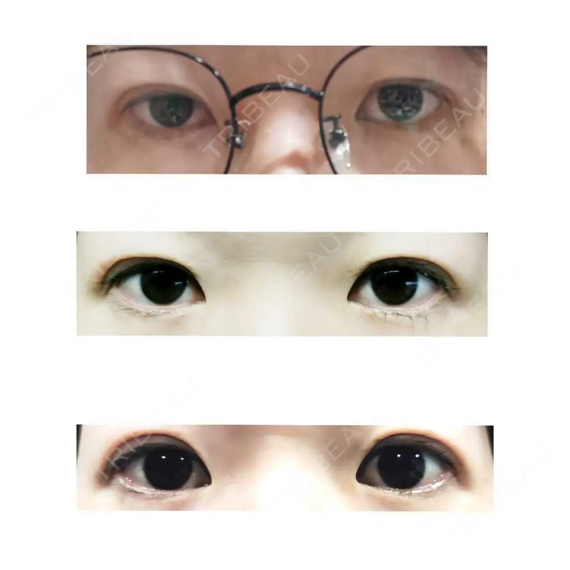 二重埋没 さくら美容外科 DAY 0