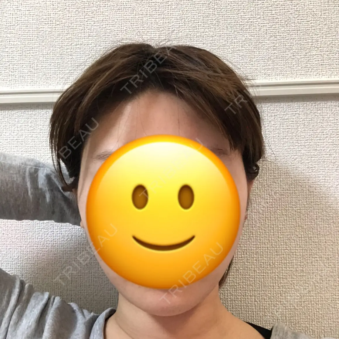 脂肪溶解注射（顔） 東京ロイヤルクリニック AFTER
