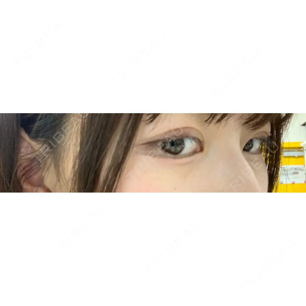 二重埋没 / 上まぶたの脂肪取り / 下まぶたの脂肪取り 東京形成美容外科 船橋院 AFTER