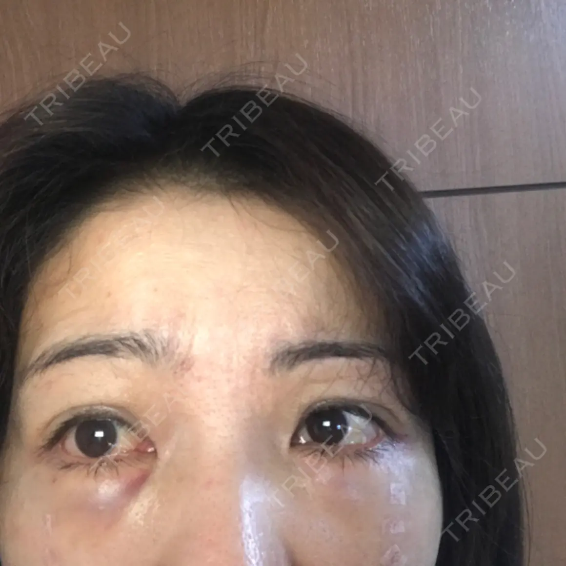 クマ治療 / 前額リフト 湘南美容クリニック 千葉センシティ院 DAY 1