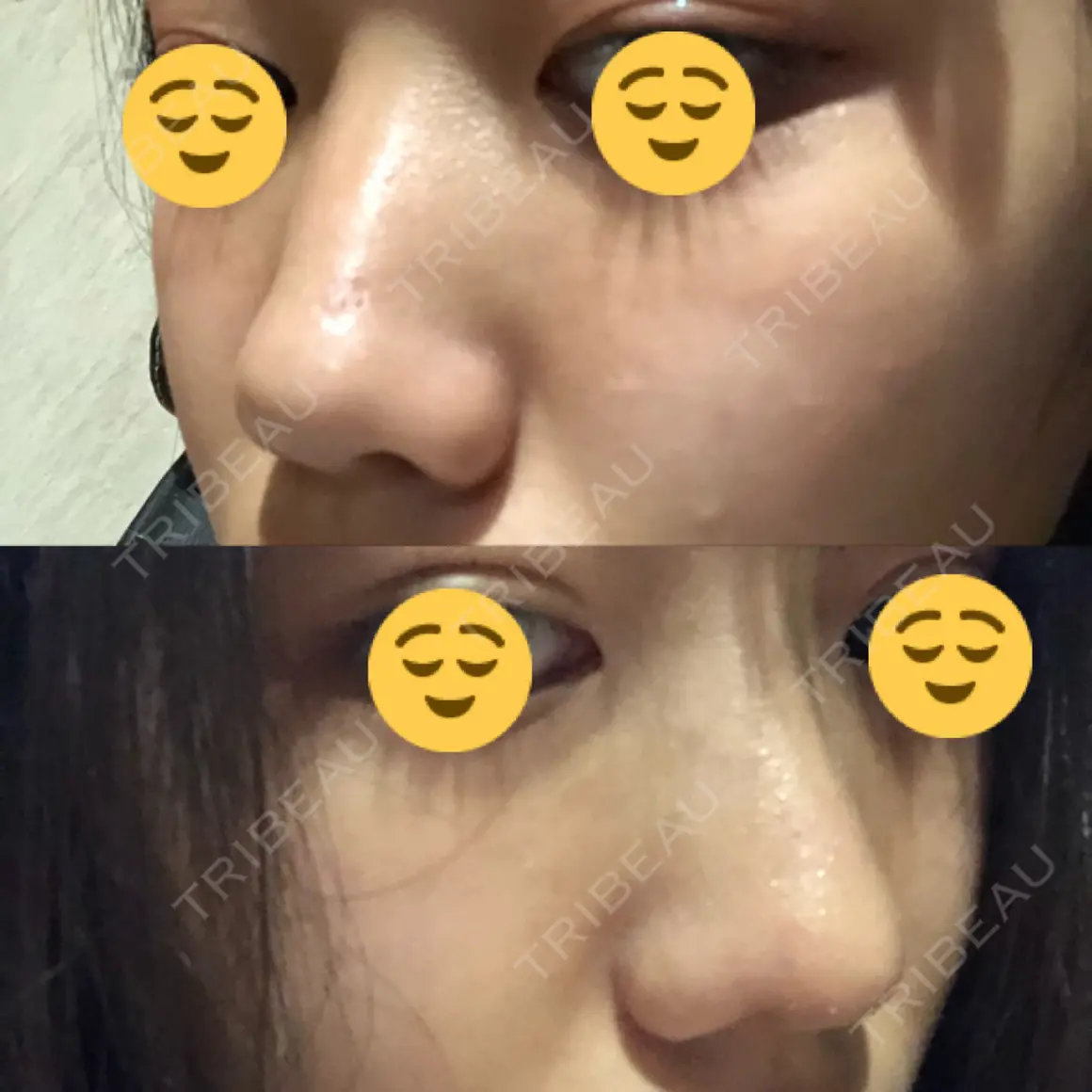 隆鼻術 / 鼻尖形成（切開） 品川美容外科 千葉院 AFTER