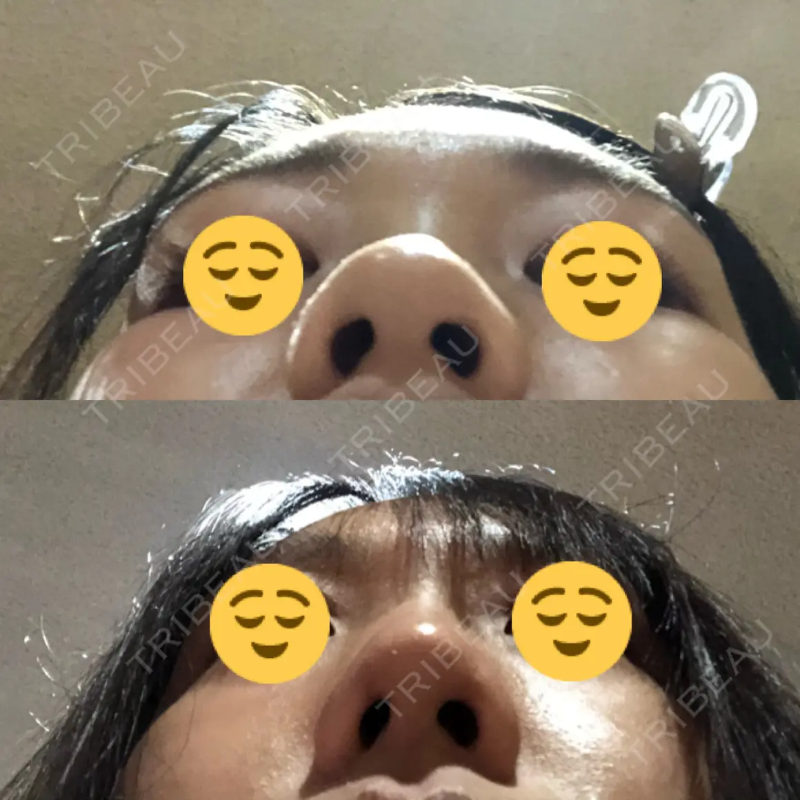隆鼻術 / 鼻尖形成（切開） 品川美容外科 千葉院 AFTER