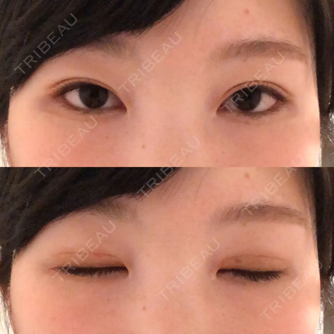 二重切開 / 目頭切開 銀座高須クリニック AFTER