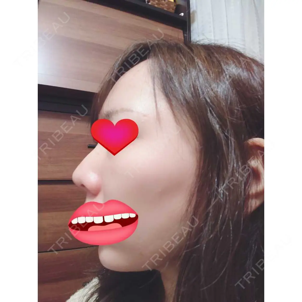 軟骨移植 フェアクリニック川口 AFTER