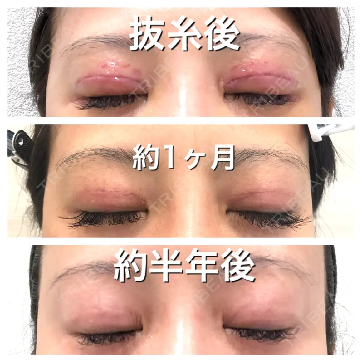 二重切開 / 上まぶたの脂肪取り BIANCA銀座 AFTER