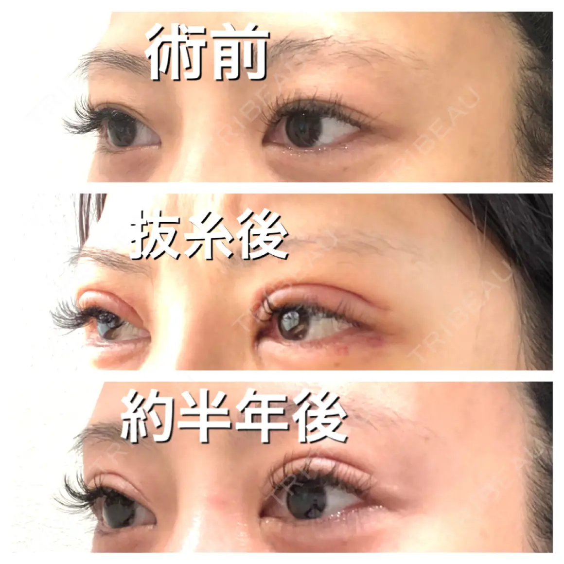 二重切開 / 上まぶたの脂肪取り BIANCA銀座 AFTER