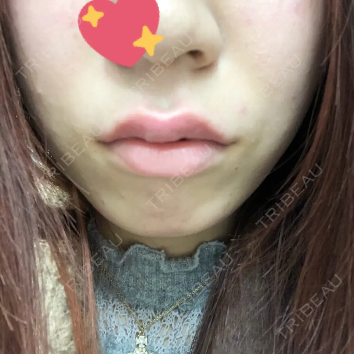 ヒアルロン酸注入（唇） / ボトックス（口角） アクトリー勝どきウェルネスメディカルクリニック DAY 0